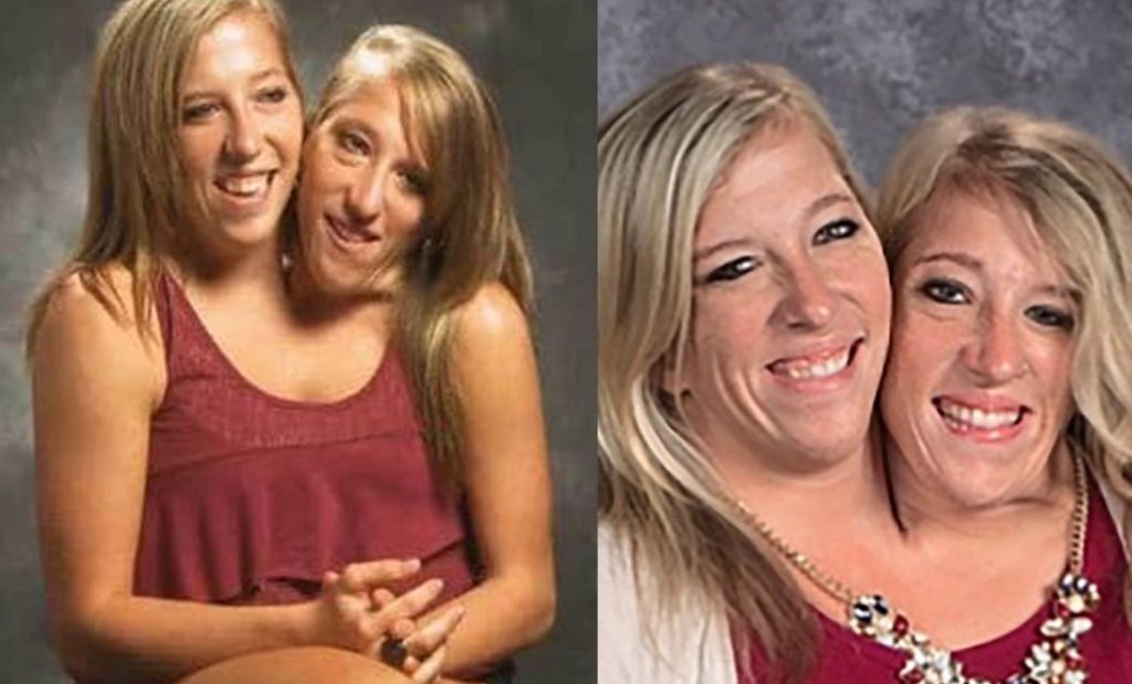 Everything To Know About Famous Conjoined Twins Abby And Brittany