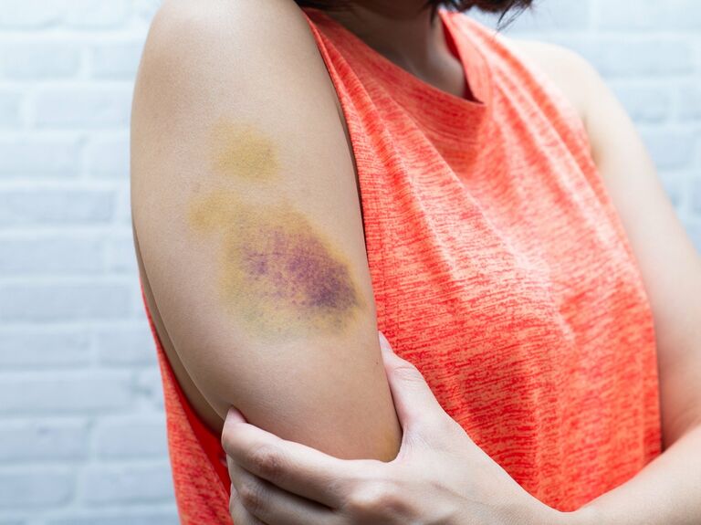 Heal Bruises Quickly